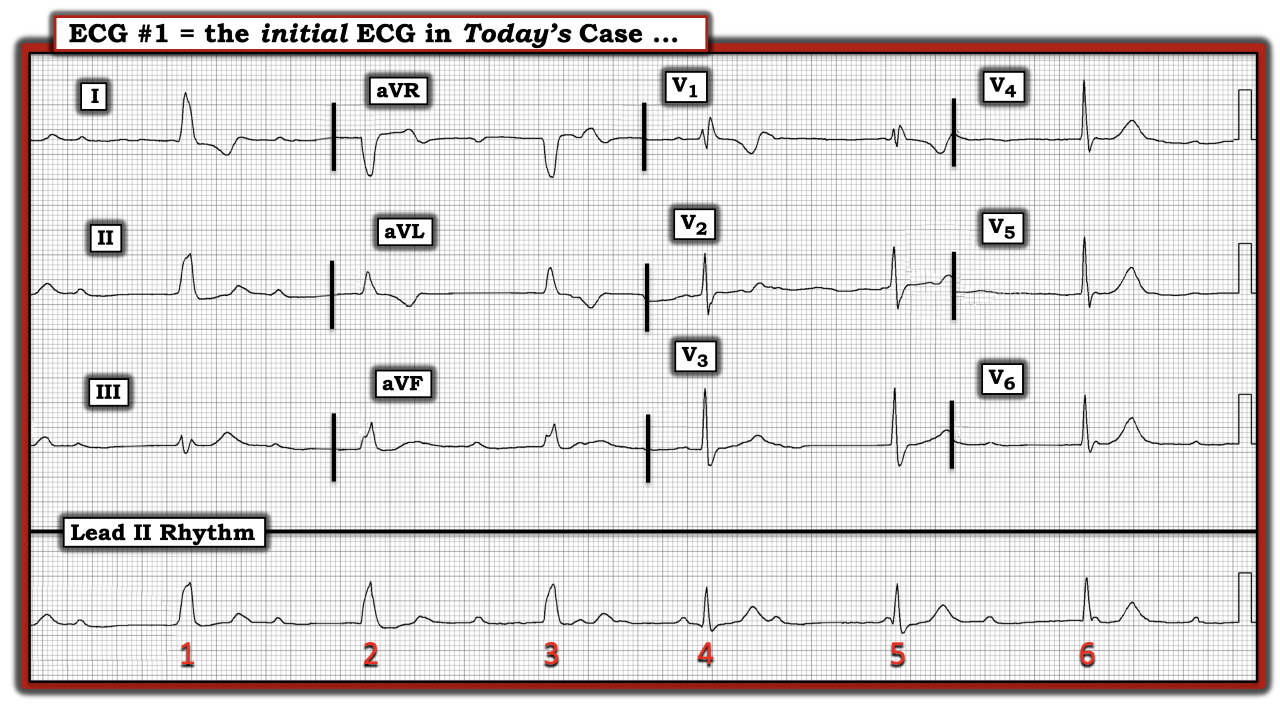 ECG Review April 15, 2023 IM
