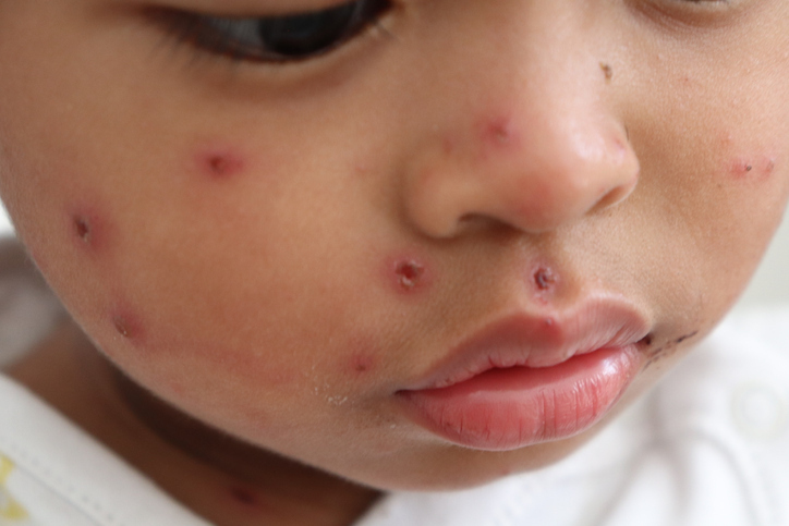 Measles face